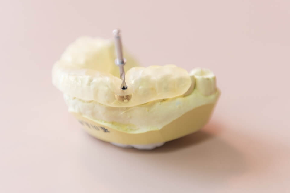 歯が抜けてしまった時の治療方法の一つがインプラントです。