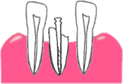3.歯周組織が修復される。